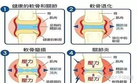 干细胞治疗 让11种重大疾病不再可怕