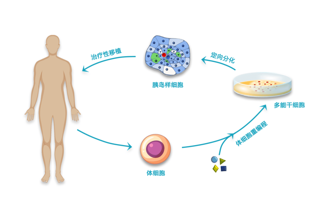 世界首例!干细胞实现"功能性治愈"1型糖尿病,未来有望不打胰岛素?_管