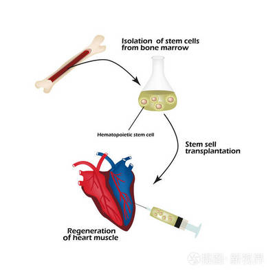 干细胞从骨髓被用来再生心脏肌肉。信息.矢量插图